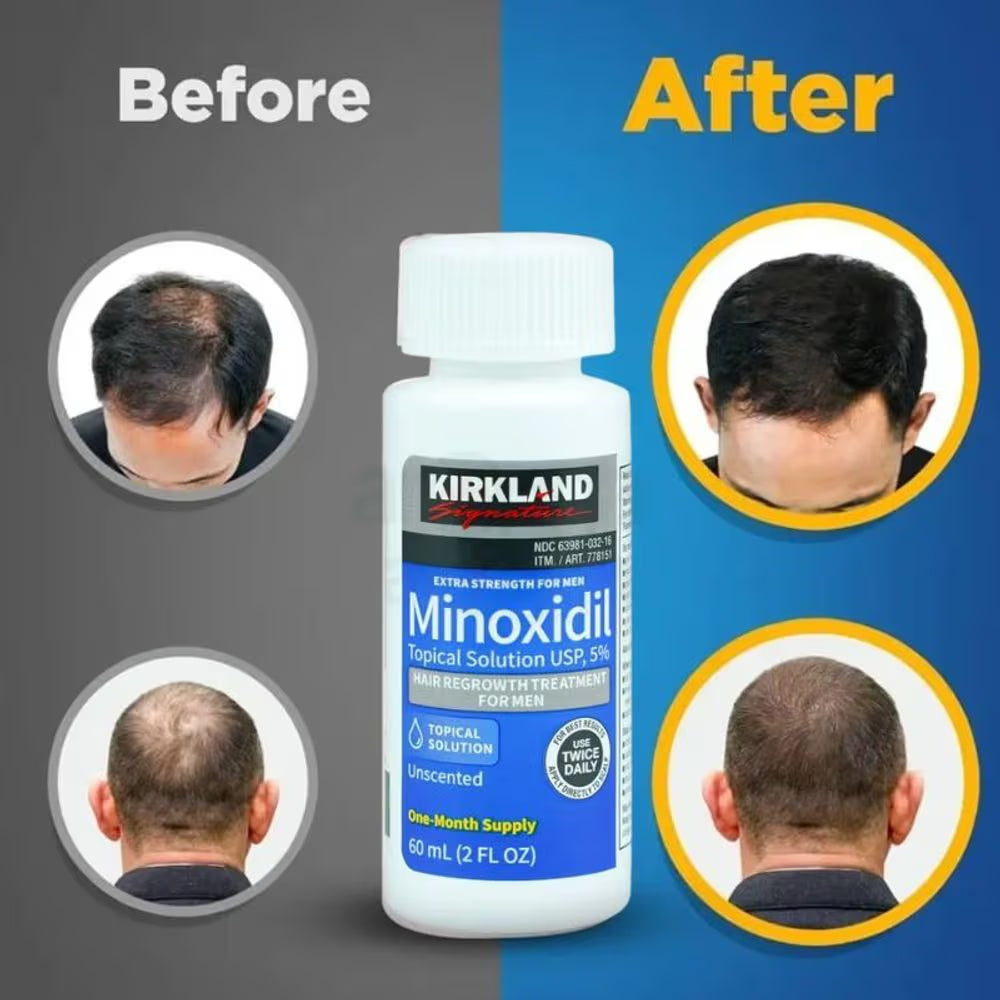 Kirkland Minoxidil 5% Hair Regrowth Treatment – 6 Month Supply 💧🔥